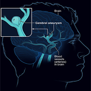 Cerebral aneurysm formation, fluid flow and vascular phenotype